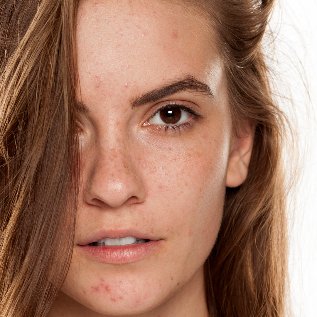 Best Acne Skin Care Kit National Acne Positivity Day Dp Derm