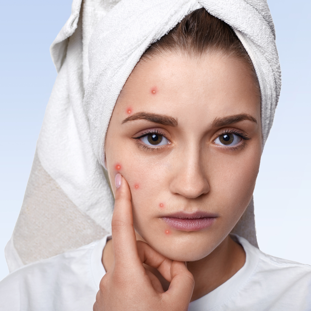 step-by-step-skin-care-routine-for-acne-prone-skin-dp-derm