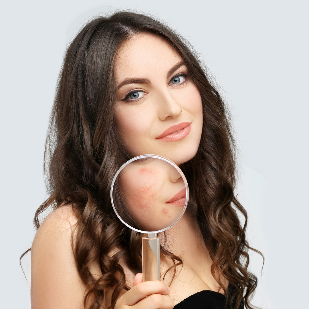 Best Treatments and Skin Care for Acne Dp Derm