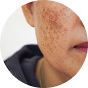 Aging or sun-damaged skin