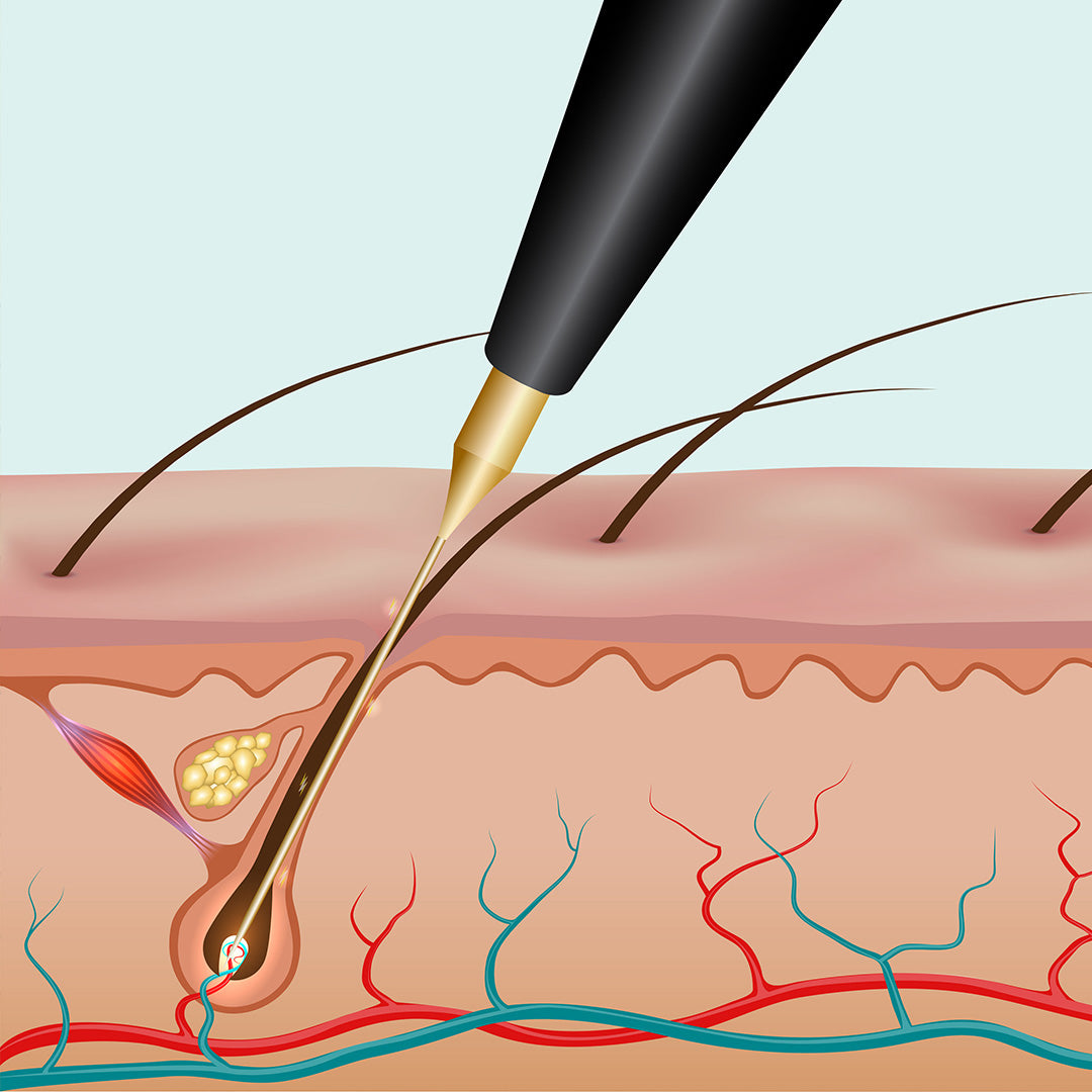 1992–1997 — Needle Dermabrasion