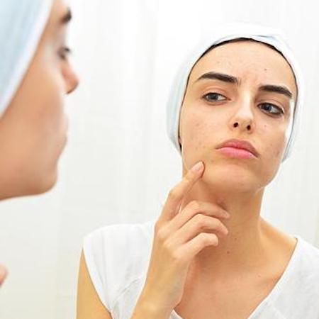 Acne Management: Post-Procedure Tips & Tricks