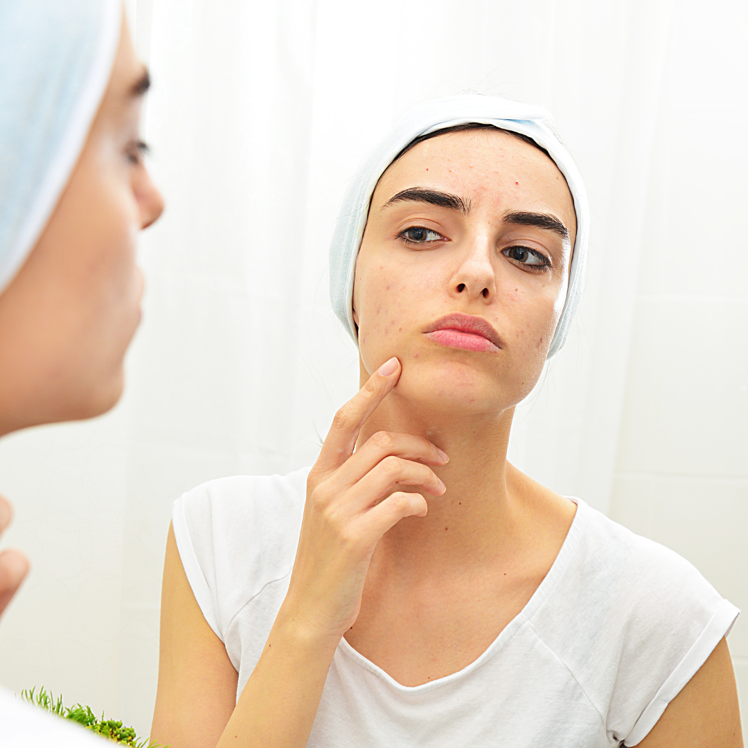 Cystic Acne: An Explanation, Causes, and Treatments