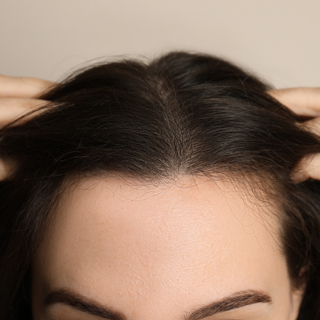 How to Manage and Prevent Hair Loss in Women