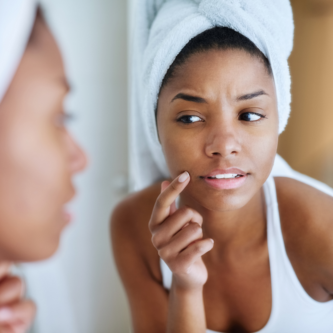 How to Avoid a Holiday Acne Breakout