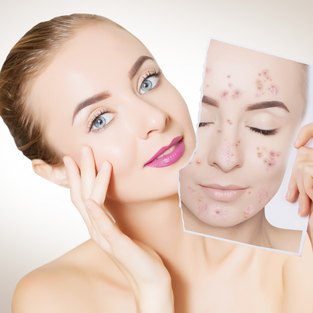 Spring Skin Care Tips for Preventing Acne